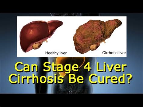 Yes: Unfortunately <b>cirrhosis</b> is an irreversible process and some of the inflammatory activity that leads to scarring of the <b>liver</b> may proceed in absence of. . How i cured my liver cirrhosis